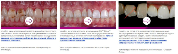 Filtek Universal Restorative Kit  3М, США