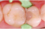 Beautifil-Bulk Restorative композит для реставрации  жевательной группы зубов, вносимый одним слоем 4 мм SHOFU, Япония