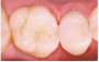 Beautifil-Bulk Restorative композит для реставрации  жевательной группы зубов, вносимый одним слоем 4 мм SHOFU, Япония