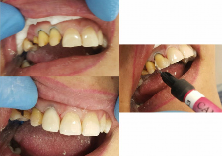 Camouflage (8) Megadenta Dentalprodukte, Германия