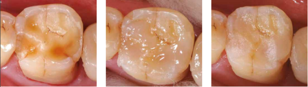 Beautifil Flow Plus «F00» SHOFU Dental, Япония