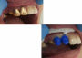 Camouflage (8) Megadenta Dentalprodukte, Германия