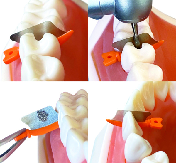 Матричные клинья с защитой W3 WEDGE GUARDS (Средние), ZTDENTAL, Китай