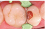 Beautifil-Bulk Restorative композит для реставрации  жевательной группы зубов, вносимый одним слоем 4 мм SHOFU, Япония